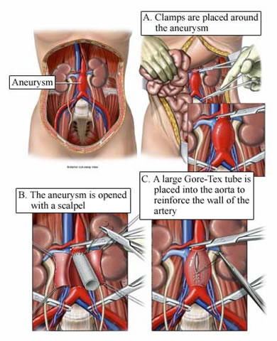 Thoracic Aortic Aneurysm It S Causes Queensland Vascular