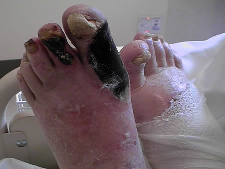  of a patient with “dry” gangrene caused by peripheral vascular disease