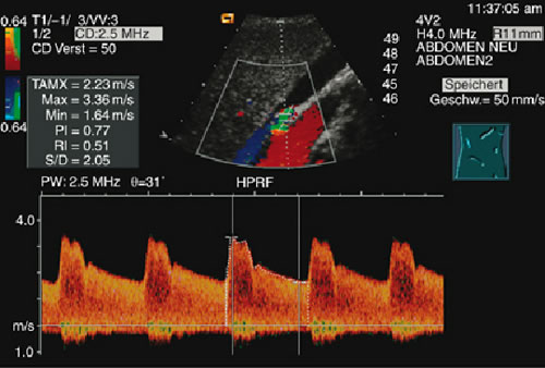 duplex ultrasound